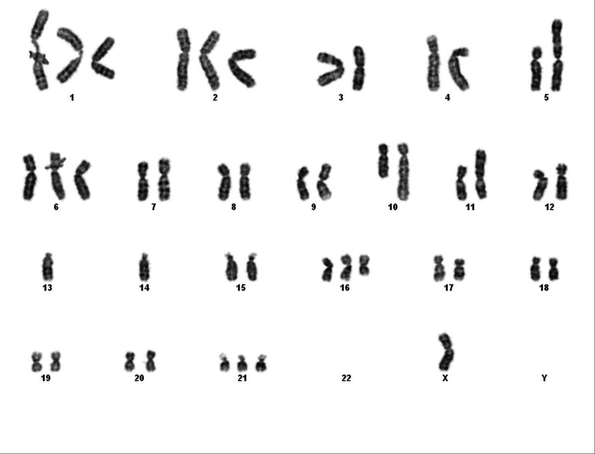 Karyogram of spinal mass showing complex cytogenetic abnormalities